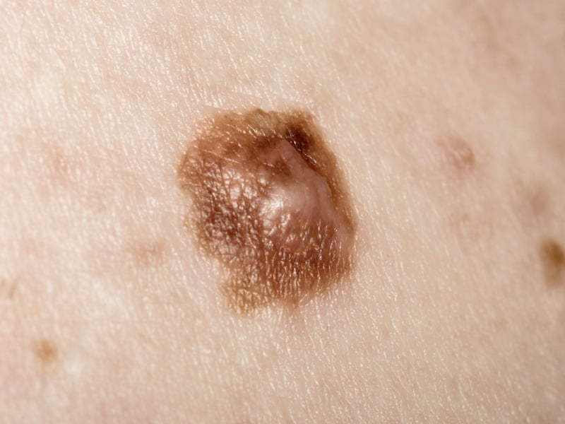 melanoma skin moles