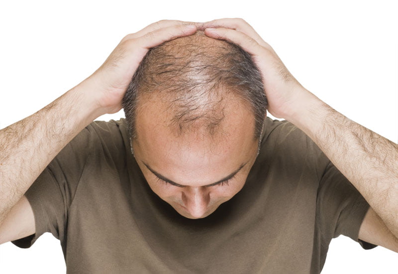 Hair Loss - Thomson Specialist Skin Centre