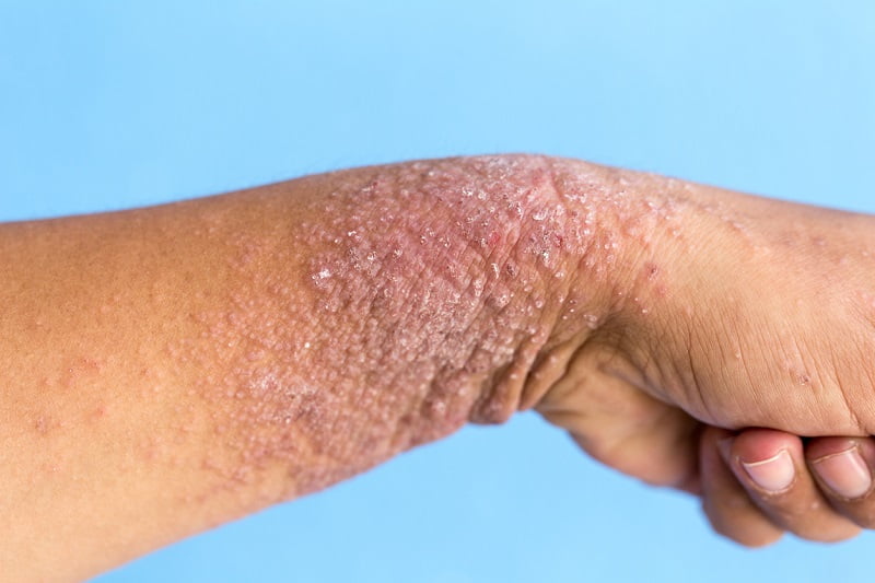Hand dermatitis, Eczema on hand.