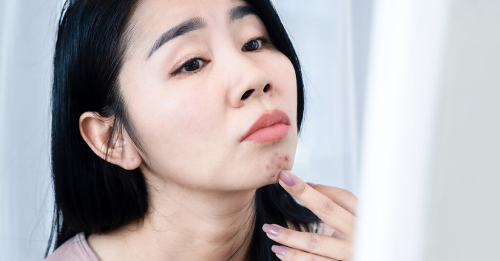 Acne Symptoms and Causes-dermatologists Singapore