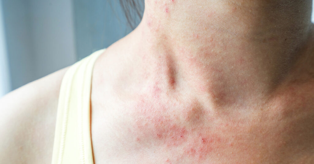 Atopic Dermatitis Symptoms and Causes-dermatologists Singapore