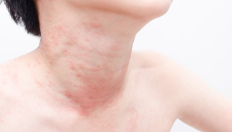 Hives on Adults and Children