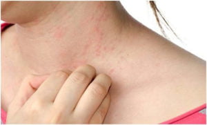 Woman scratching hives rash