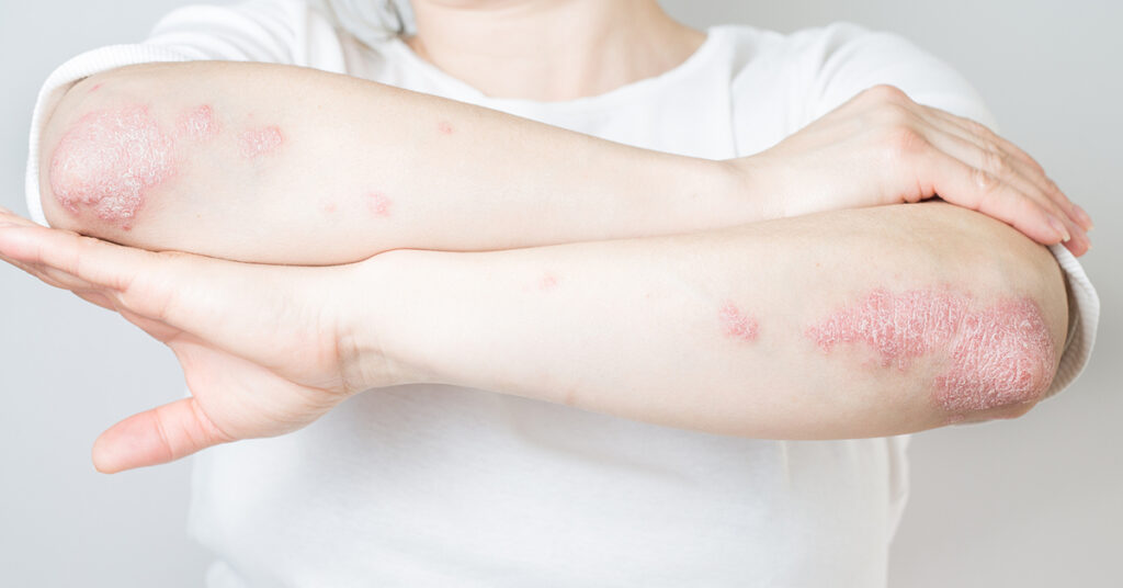 Psoriasis Symptoms and Causes-dermatologists Singapore