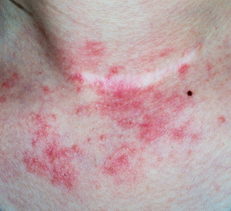Eczema on neck of a woman