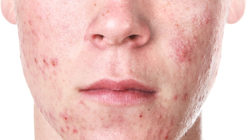 man with acne skin dermatology